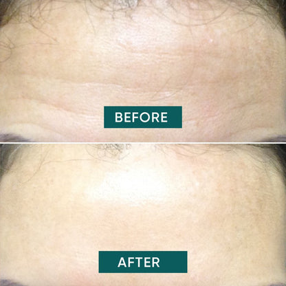 APRICOT Forehead Pad Hyaluron - fantastic forehead - 30 Treatments - Glow and Vital