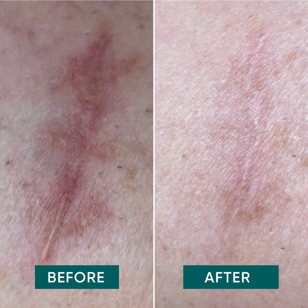 NEW - APRICOT Scar Pads with Aloe Vera - 30 Treatments - Glow and Vital